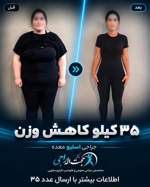 عکس قبل و بعد عمل اسلیو معده پس از ۶ ماه