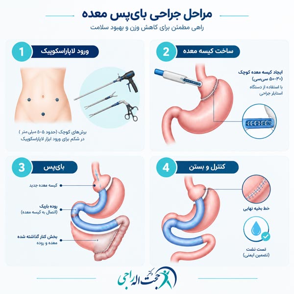 مراحل جراحی بای‌پس معده